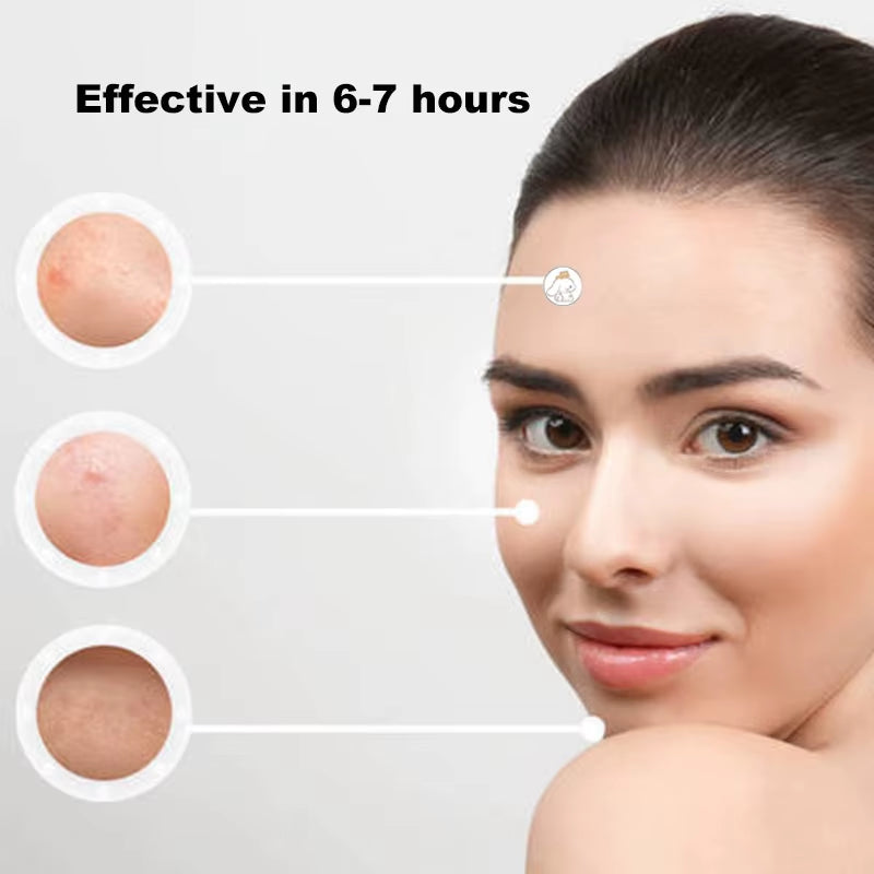 96/100/120Pcs Sanrio Cinnamoroll Repair Acne Patch Facial Skin Care Fade Blemishes Pimple Marks Closed Acne