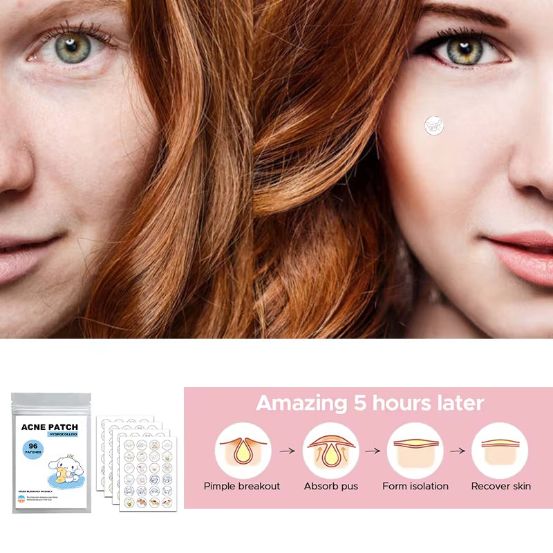 96/100/120Pcs Sanrio Cinnamoroll Repair Acne Patch Facial Skin Care Fade Blemishes Pimple Marks Closed Acne